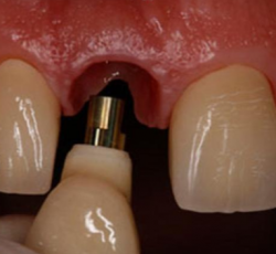 تخفیف ایمپلنت با شرایط اقساطی ( دندانپزشکی )